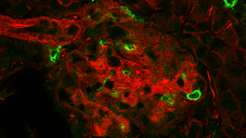 Inflammation and diabetic kidney disease: Why mitochondria matter