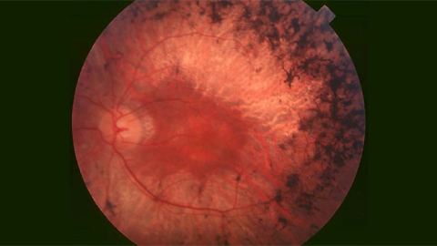 An unexpected component in retinal survival