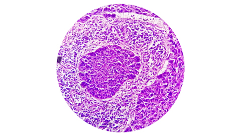 Exploring glycosylation patterns in oral cancer