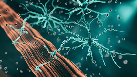 Lipid signatures for a rare neurological disorder