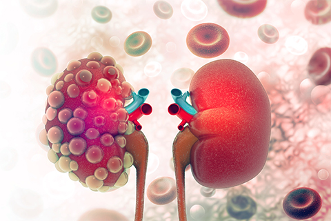 A kidney with multiple cysts (left) compared to a normal kidney (right).