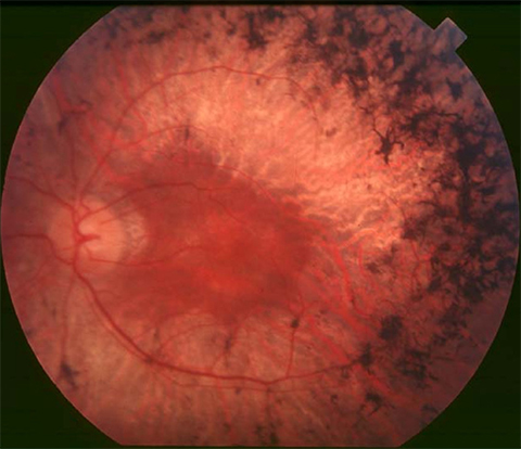 Degenerating photoreceptors contribute to conditions such as retinitis pigmentosa.