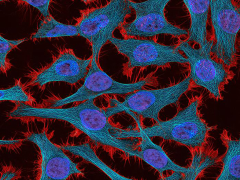 Cervical cancer, shown here at the cellular level, frequently resists treatment. The researchers’ machine learning algorithm could help scientists better understand why this and other forms of cancer resist chemotherapy.