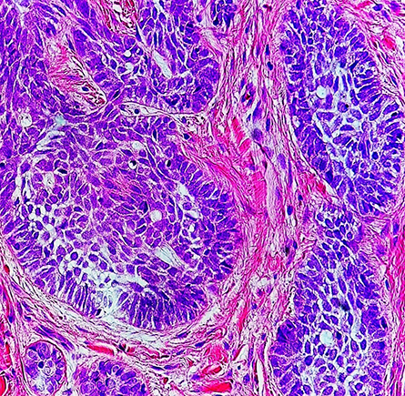 Researchers at the Vienna BioCenter combined two proteomics methods to detect signatures in skin cancer cells like those shown in this high-magnification micrograph. The cancerous cells are a darker purple than the surrounding stroma.
