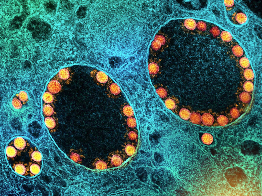 Because the virus that causes COVID-19 (gold) and other RNA viruses enter cells through endosomes, mRNA drug impurities can elicit similar immune responses.