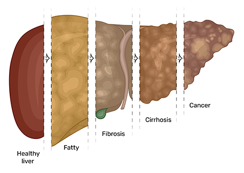 The stages in the progression of liver disease are, from left to right, healthy liver, fatty liver, fibrosis, cirrhosis and cancer.