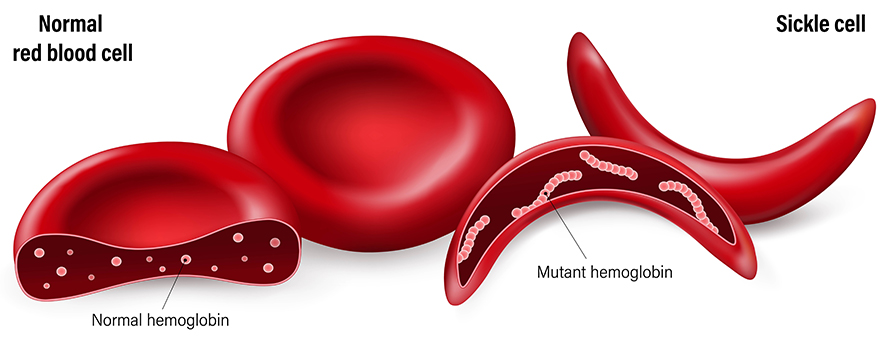 Sickle cell disease is caused by a mutation in the hemoglobin beta chain gene. This mutation causes the beta subunits of hemoglobin to stick together, resulting in warped, or “sickle”-shaped, which can lead to impaired blood flow and cause stroke, infection, eye issues, severe pain crises and premature death.