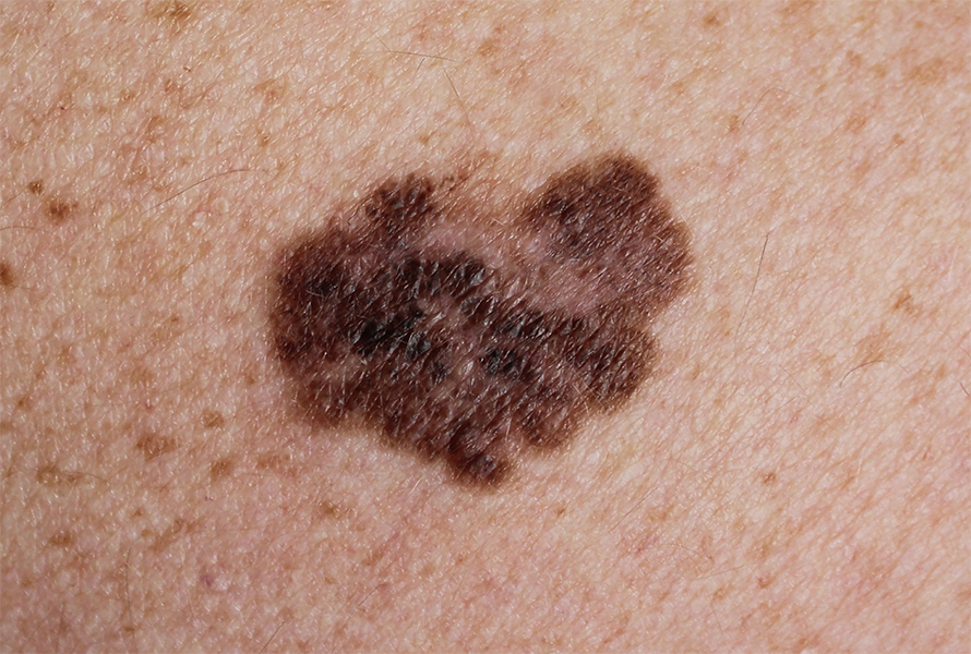 Melanoma is an aggressive form of skin cancer.