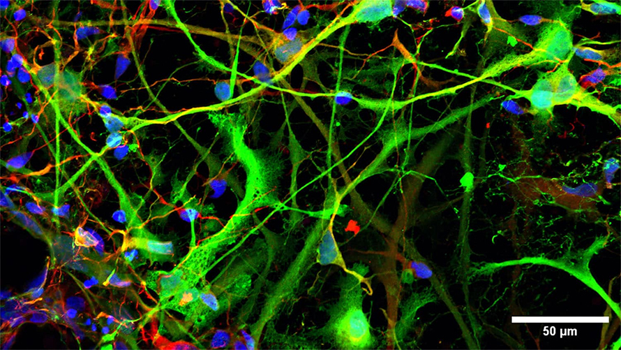 Stem cell-derived medium spiny-like neuron morphology highlighted by the green fluorescent protein GFP and neuron marker MAP2 in red.