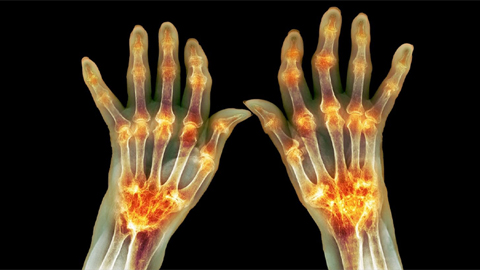 RA patient blood reveals joint innerworkings
