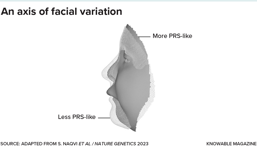 Pierre Robin sequence (PRS) is a craniofacial disorder characterized in part by a small lower jaw and caused by a mutation in the regulatory gene SOX9. Researchers sorted normal faces according to how much or how little they resembled the features of PRS, and then looked for associated gene variants. The researchers found that some genes are very sensitive to SOX9, dialing facial variation toward or away from PRS-like facial features. If other axes of facial variation are determined in a similar way, this could mean that the genetics of faces may be simpler than they seem.