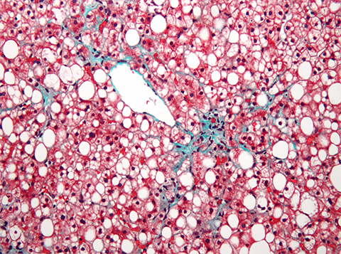 The liver has a prominent (centrilobular) macrovesicular steatosis (white/clear round/oval spaces) and mild fibrosis (green). The hepatocytes stain red. Macrovesicular steatosis is lipid accumulation that is so large it distorts the cell's nucleus.