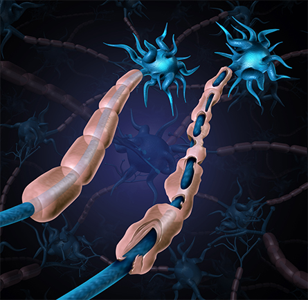 A healthy nerve sheathed in myelin (left)  contrasts with a nerve with damaged myelin as seen in multiple sclerosis and  other chronic disorders.