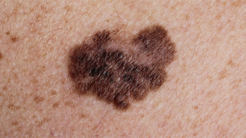 Moderna’s experimental cancer vaccine treats but doesn’t prevent melanoma