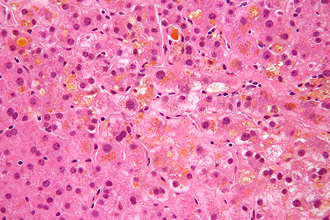 This high-magnification micrograph shows liver cholestasis.