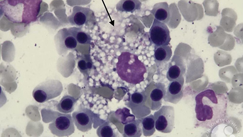 ApoA1 reduce atherosclerotic plaques via cell death pathway