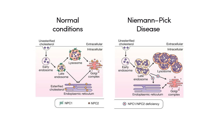 Niemann-Pick disease type C. The diagram represents subtypes and