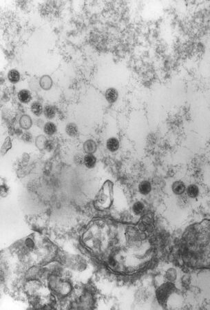 Researchers are exploring whether Epstein–Barr virus infections (shown in this transmission electron microscope image) may be linked to long COVID.