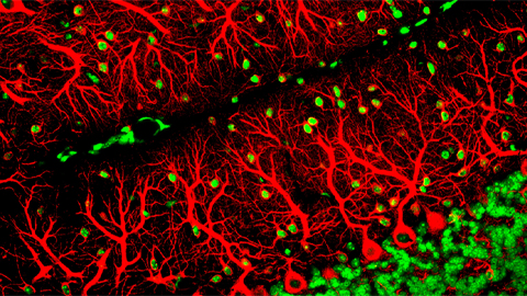 Neurodegenerative disease linked to microtubules