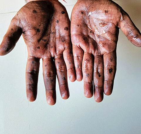 Mpox causes lesions that resemble pus-filled blisters, which eventually scab over.