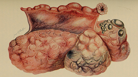 MCP: Ovarian cancer’s dark signaling pathways