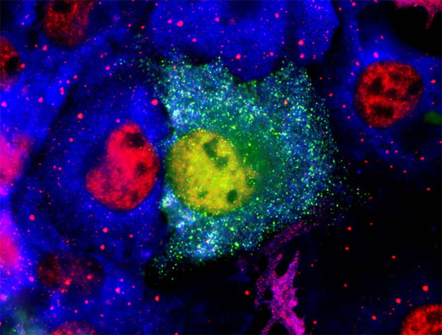 Confocal microscopy image of prion-like aggregating protein in a cell.