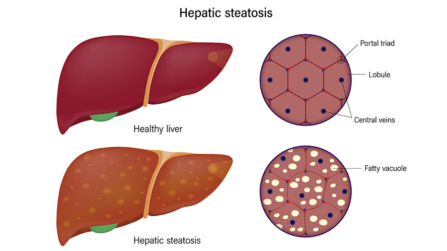 The dual role of asprosin in chronic fatty liver disease