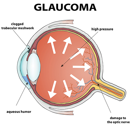Glaucoma damages the optic nerve and is a primary cause of irreversible blindness.
