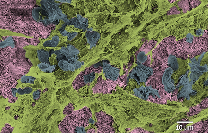 During a coronavirus infection, dying airway-lining cells (labeled blue) are ejected from areas of healthy cells (pink) slathered in mucus (green) in this colorized electron micrograph.