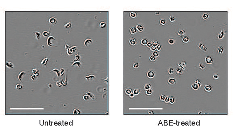 Sickle cell hematopoietic stem and progenitors from human patients were edited using a custom adenine base editor (ABE). Shown are untreated and treated reticulocytes, or immature red blood cells, after being subjected to oxygen deprivation to assess sickling.