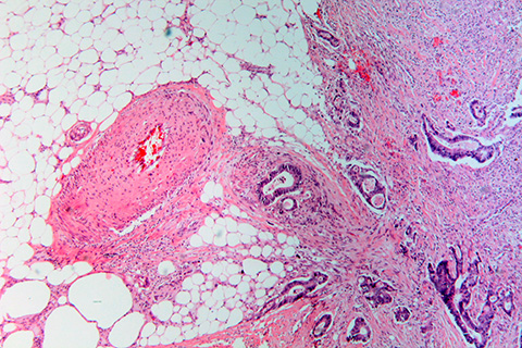 Altered glycosylation in cells could be associated with the malignant transformation in colon cancer.