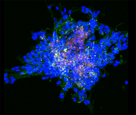 This fluorescent microscopy image shows an invasive breast tumor derived from breast cancer cells in a matrix that mimics human breast tissue. The nucleus is blue, F-actin is green, and vimentin is white and pink.